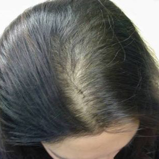 female pattern hair loss